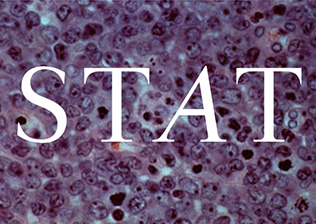 Read more about the article Allogene Therapeutics’ CAR-T Treatment Eliminates Residual Cancer Cells in B-cell Lymphoma Patients